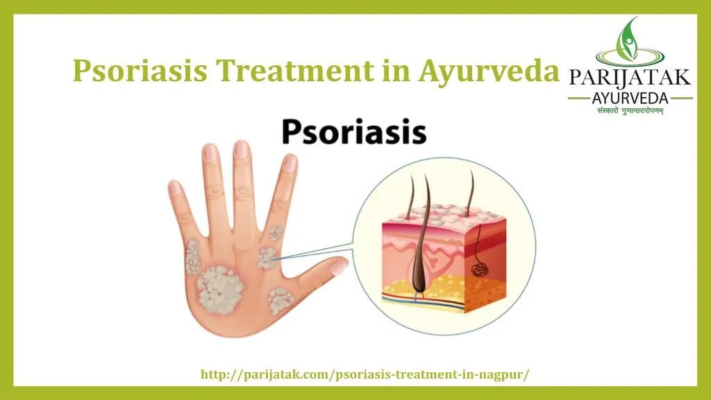 psoriasis treatment in ayurveda