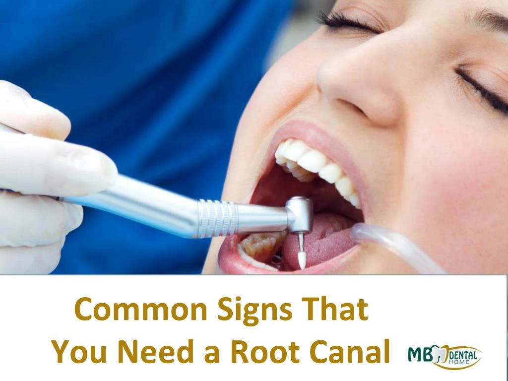 common signs that you need a root canal
