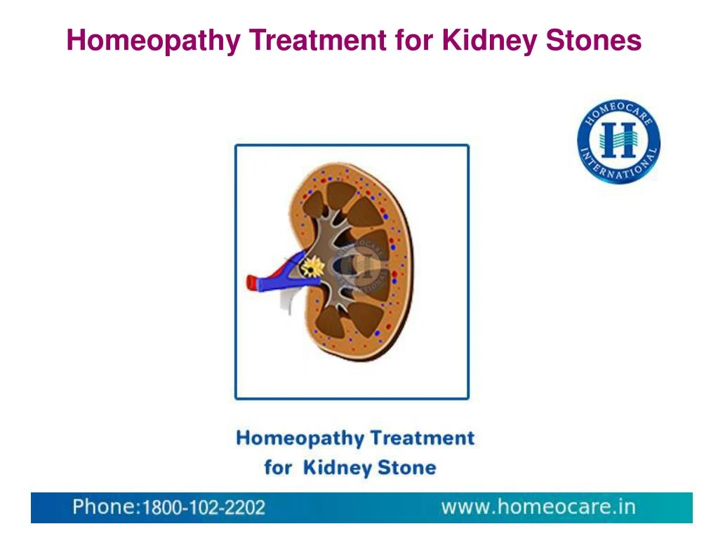 homeopathy treatment for kidney stones
