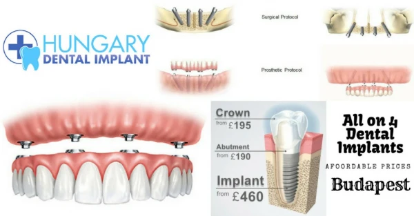 All On 4 Dental Implant In natural smile