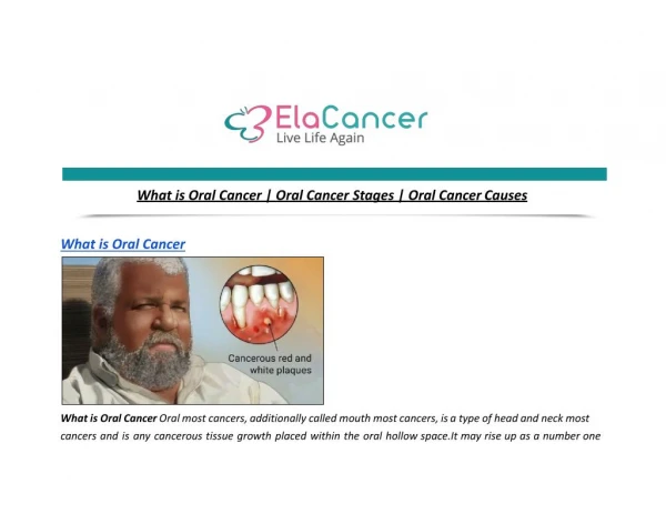 What is Oral Cancer | Oral Cancer Stages | Oral Cancer Causes