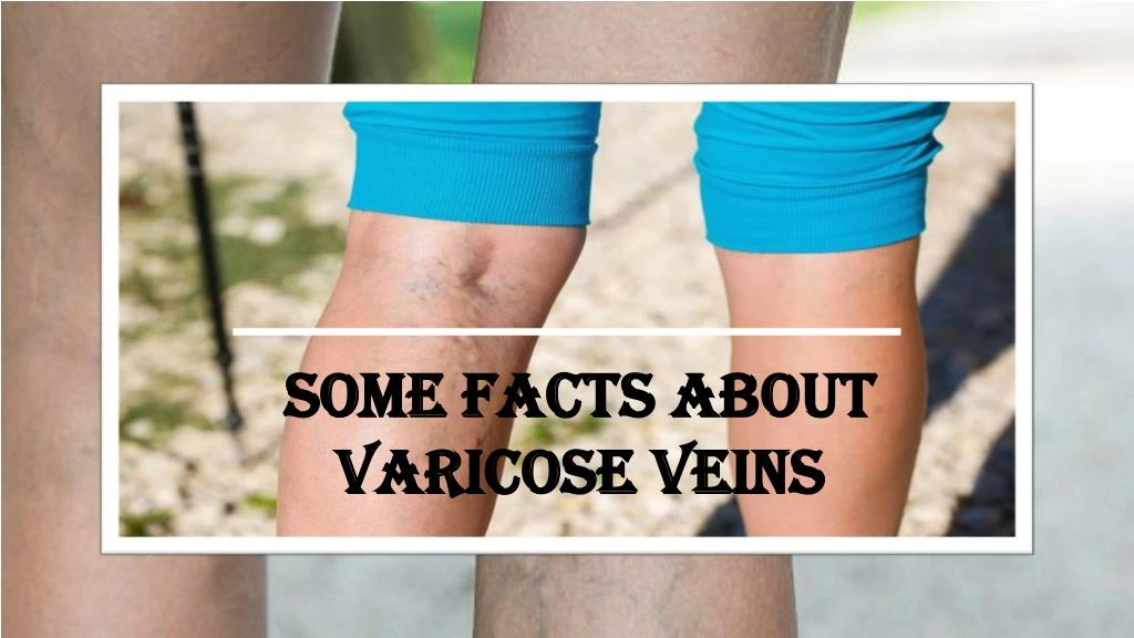 some facts about varicose veins