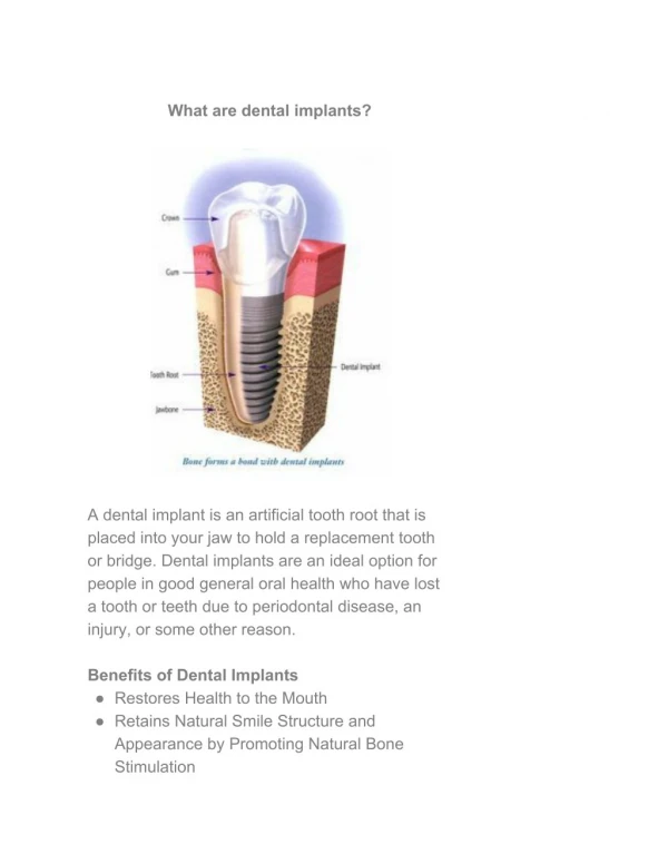 What are dental implants?