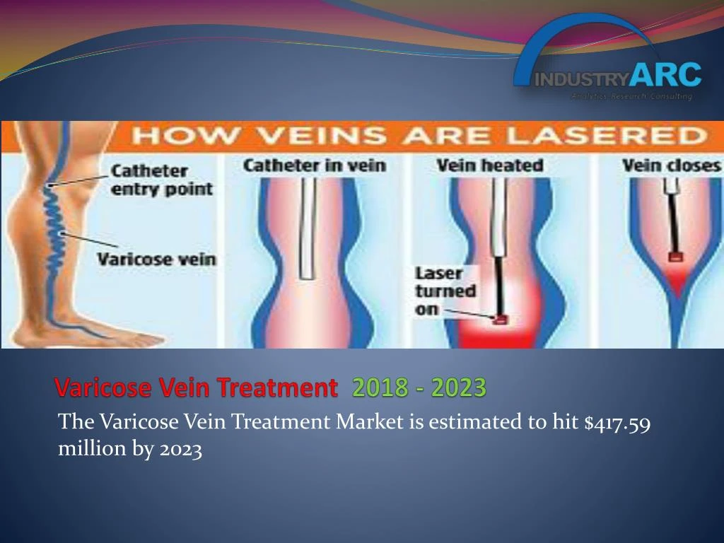 varicose vein treatment 2018 2023
