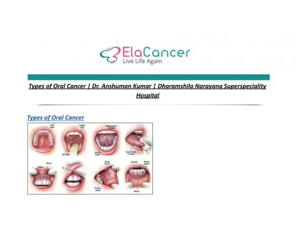Types of Oral Cancer | Dr. Anshuman Kumar | Dharamshila Narayana Superspeciality Hospital