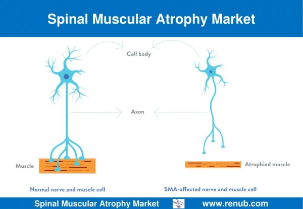 Spinal Muscular Atrophy Market Size