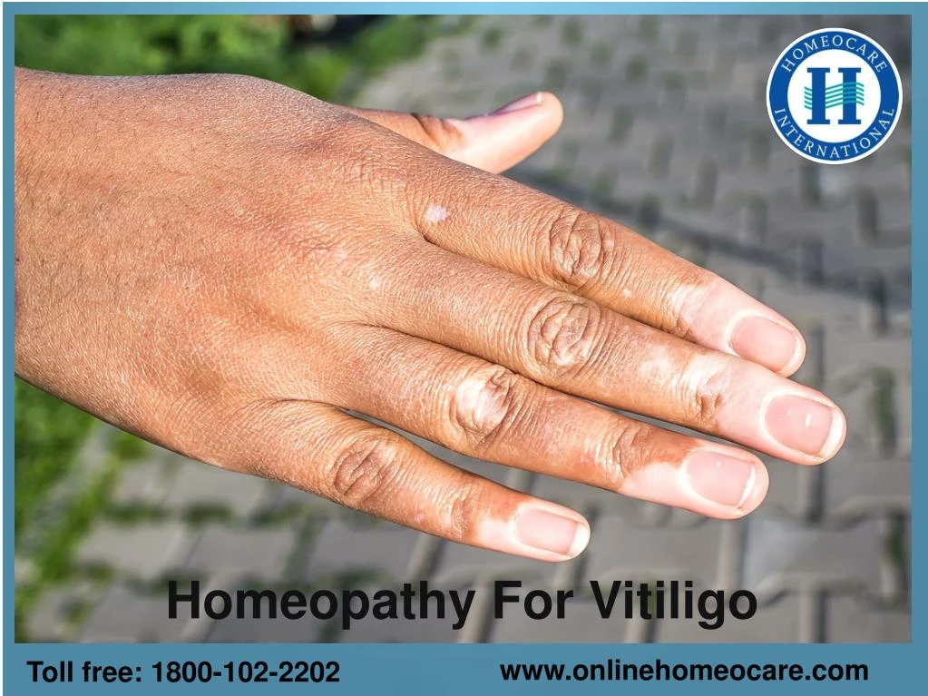 homeopathy for vitiligo