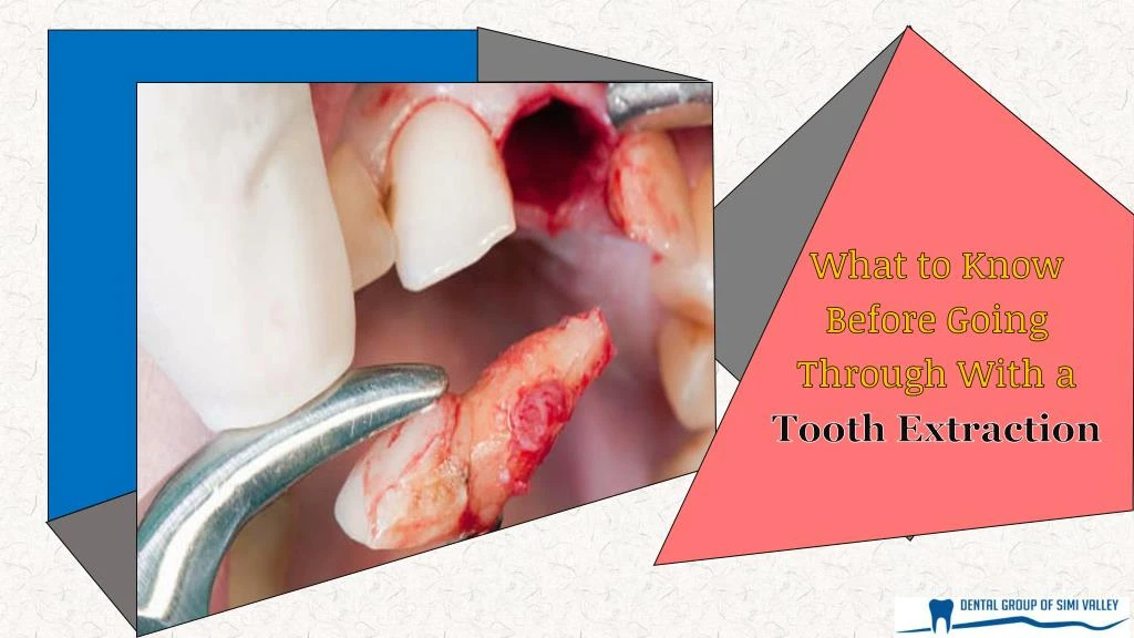what to know before going through with a tooth
