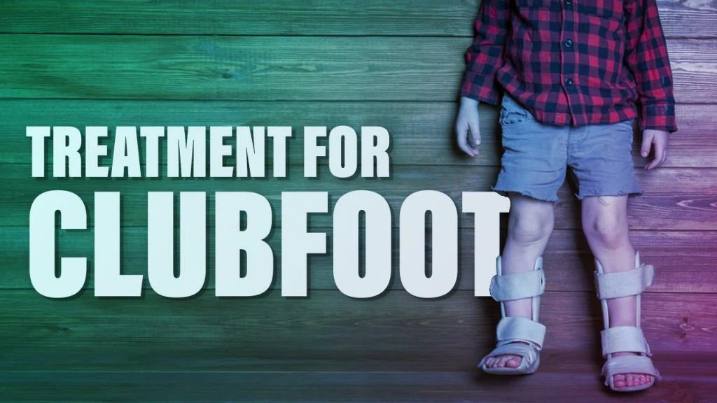 treatment for clubfoot