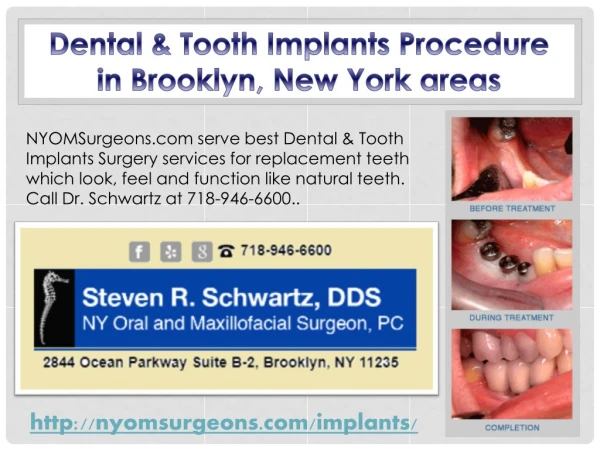 Dental & Tooth Implants Procedure in Brooklyn, New York areas - NYOMSurgeons.com