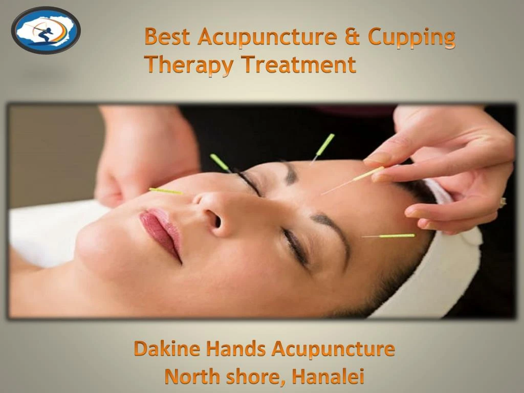 best acupuncture cupping therapy treatment