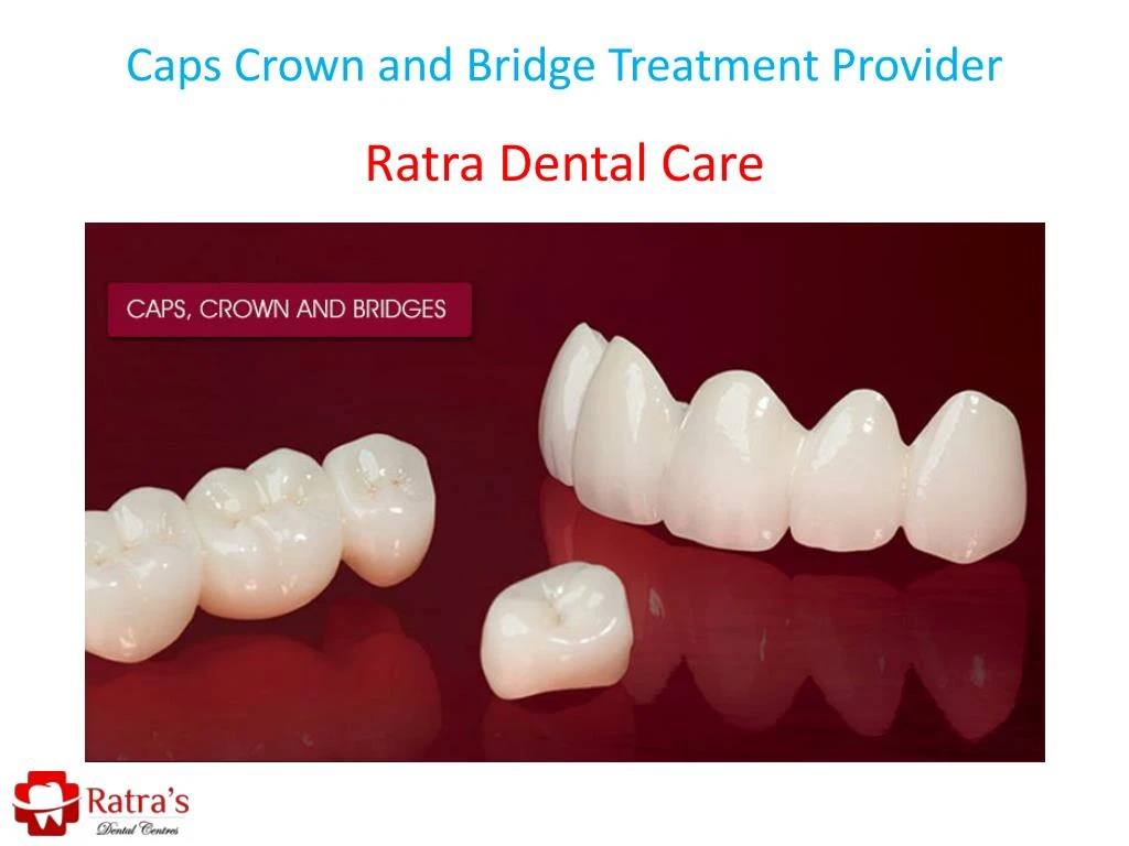 caps crown and bridge treatment provider