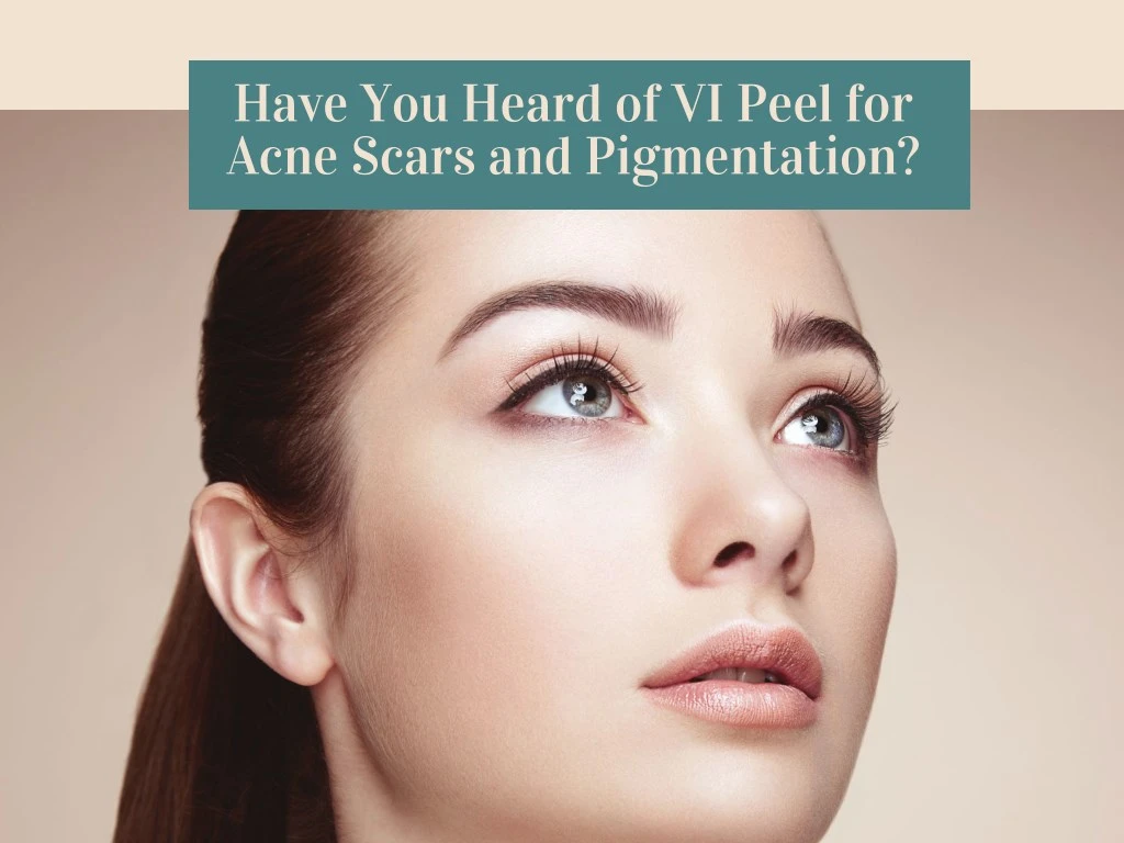 have you heard of vi peel for acne scars