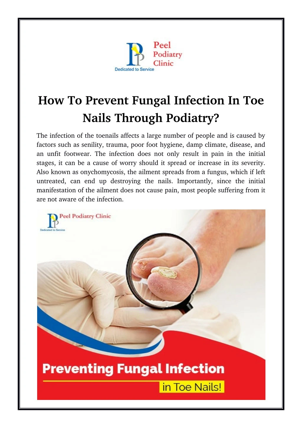 how to prevent fungal infection in toe nails