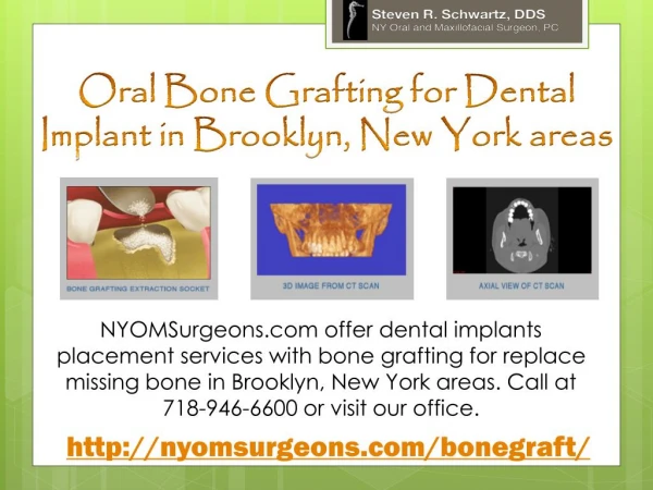 Oral Bone Grafting for Dental Implant in Brooklyn, New York areas - NYOMSurgeons.com