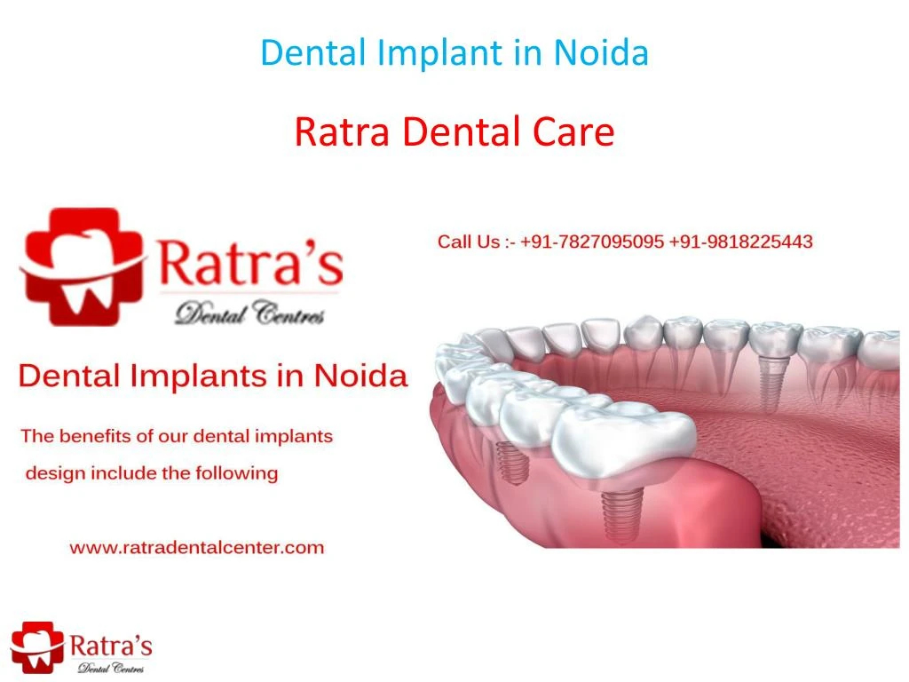 dental implant in noida