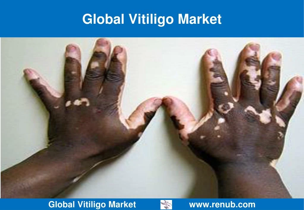 global vitiligo market