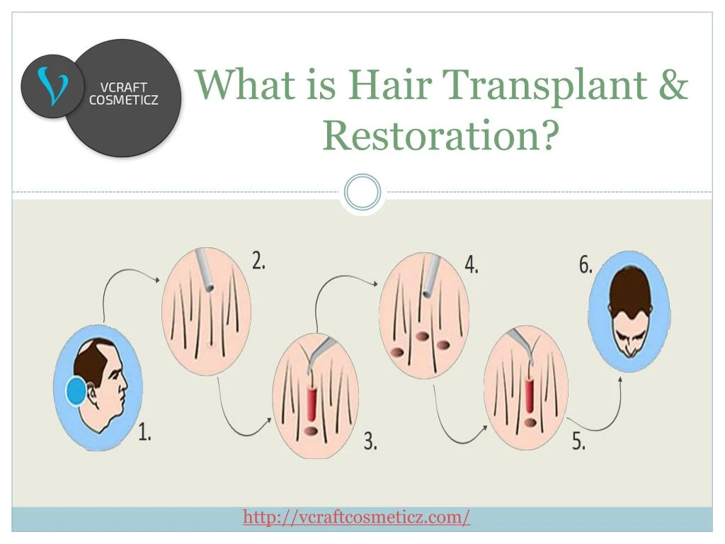 what is hair transplant restoration