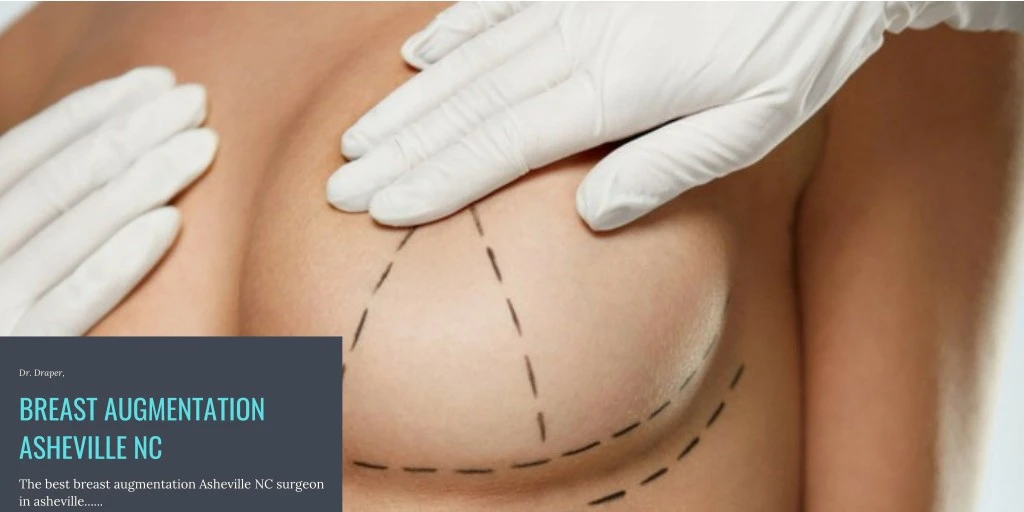 dr draper breast augmentation asheville nc