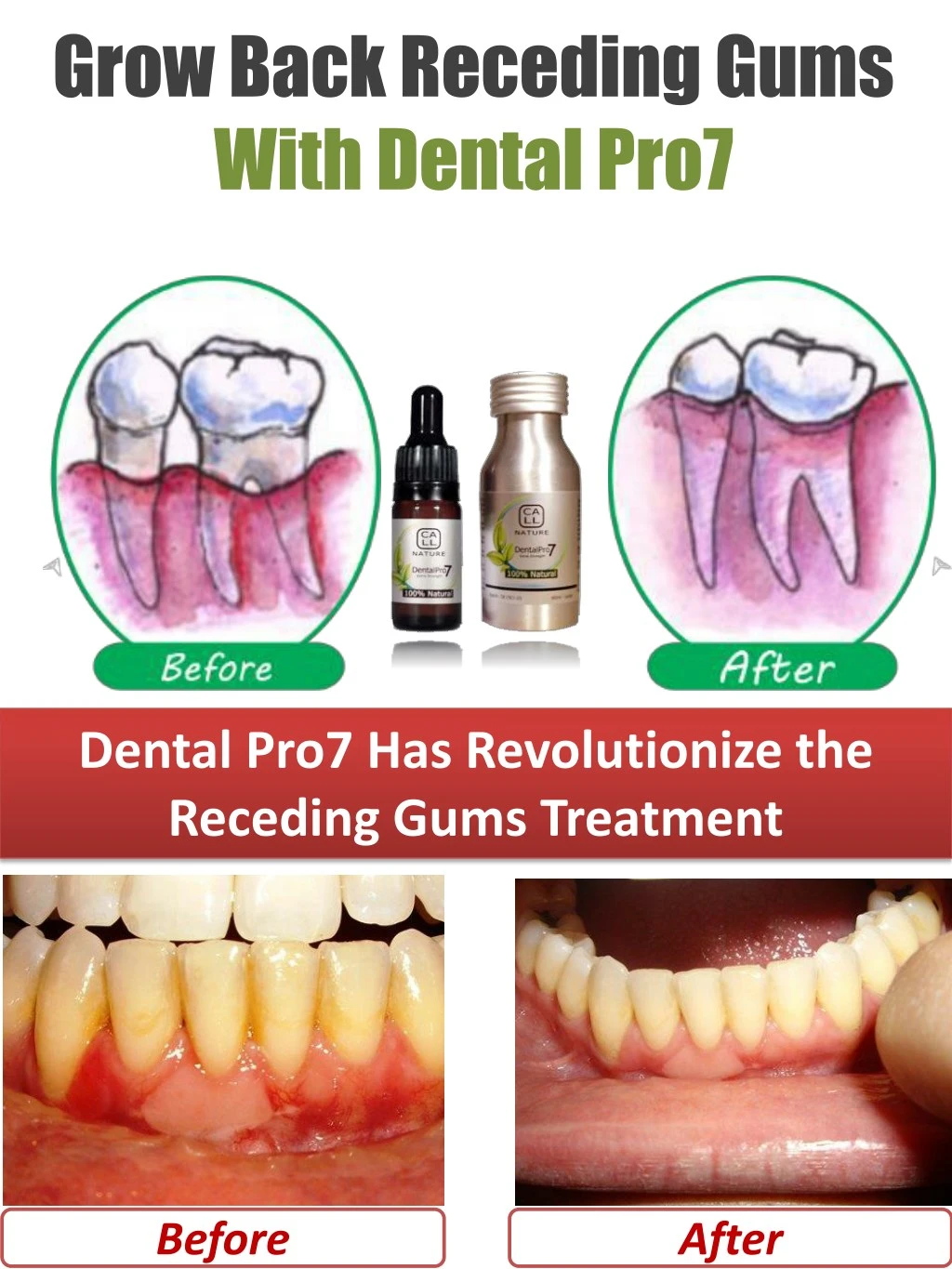 grow back receding gums with dental pro7