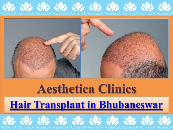 Hair Transplant in Bhubaneswar