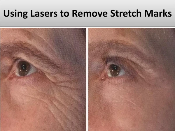 Using Lasers to Remove Stretch Marks