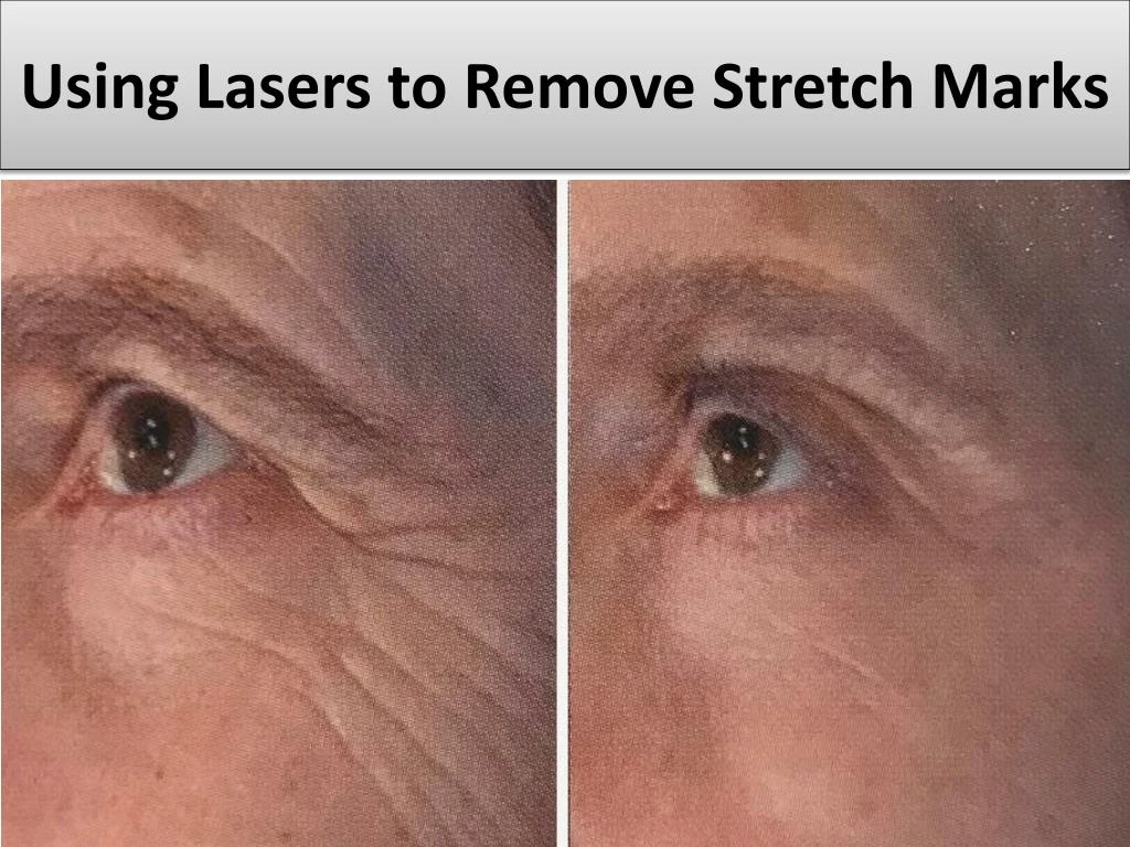 using lasers to remove stretch marks
