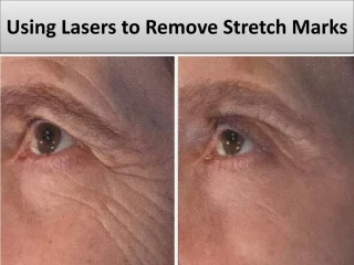 Using Lasers to Remove Stretch Marks