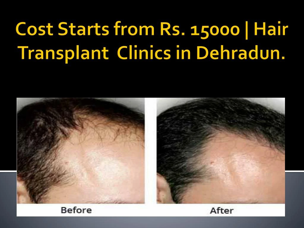 cost starts from rs 15000 hair t ransplant clinics in dehradun