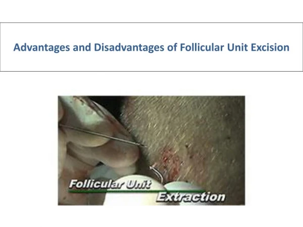Advantages and Disadvantages of Follicular Unit Excision