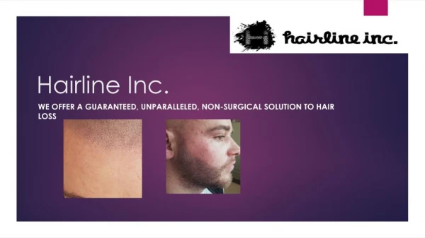 Scalp Micro pigmentation | Hairline Inc