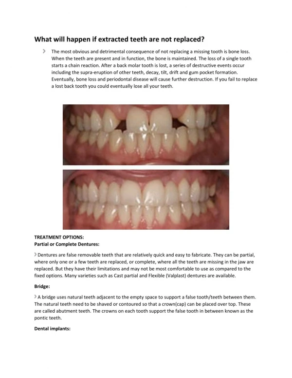 Replacement of Missing Teeth