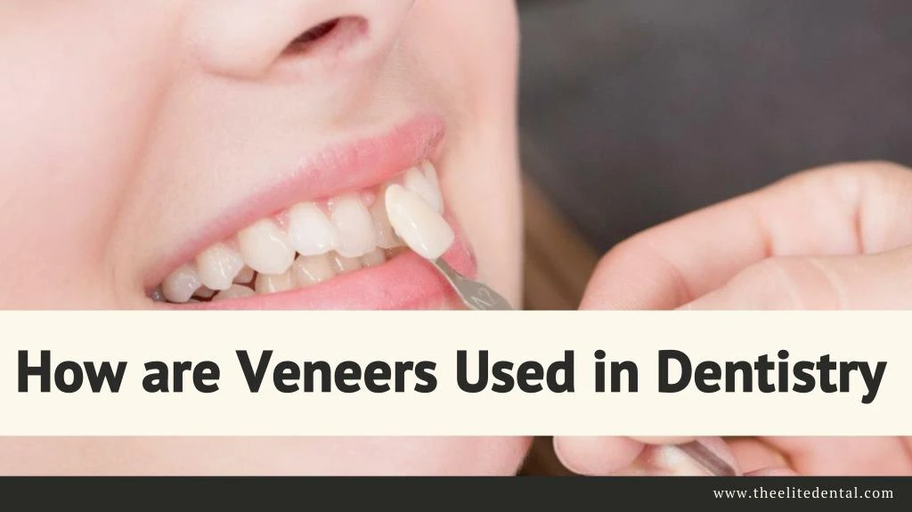 how are veneers used in dentistry