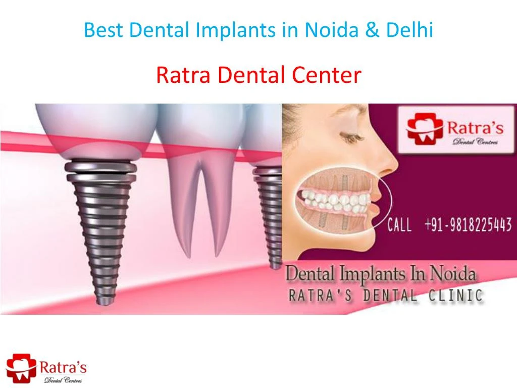 best dental implants in noida delhi