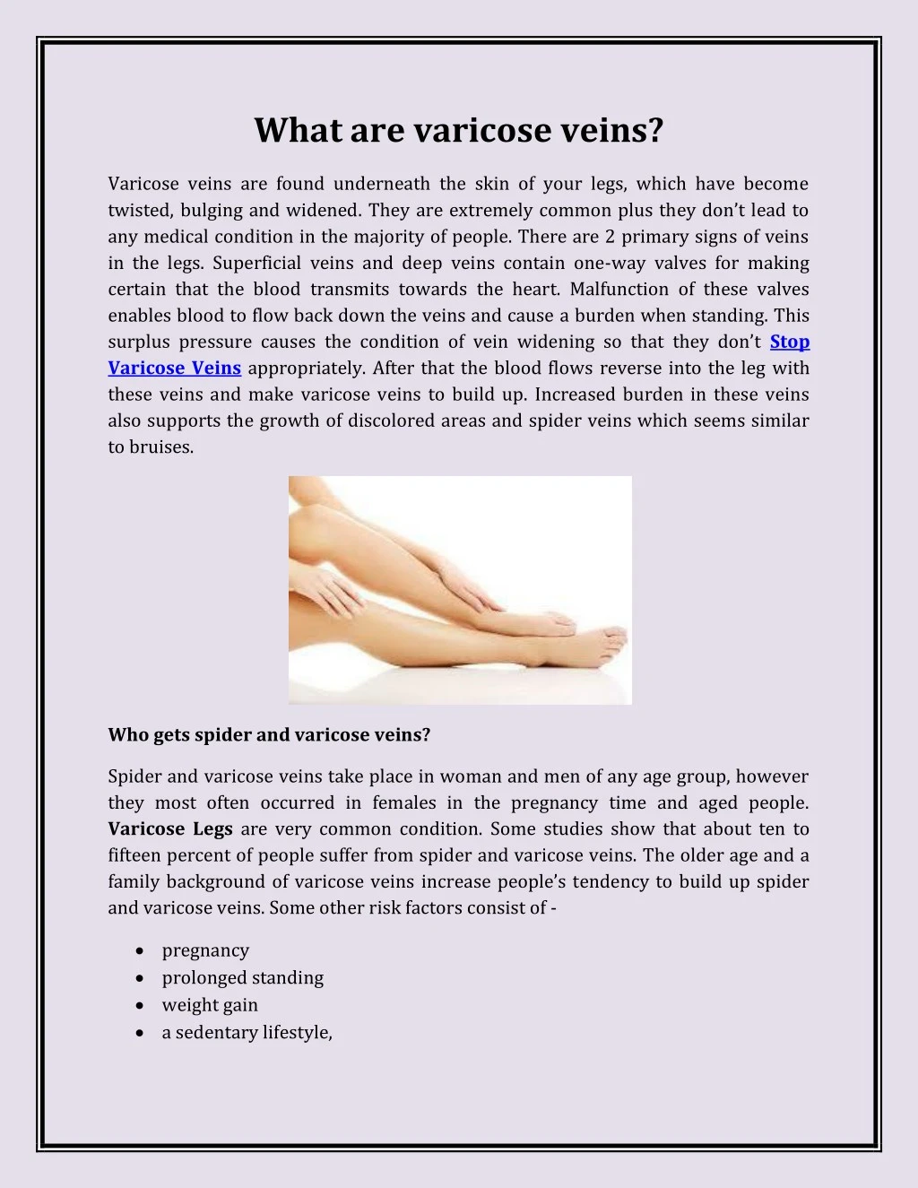 what are varicose veins