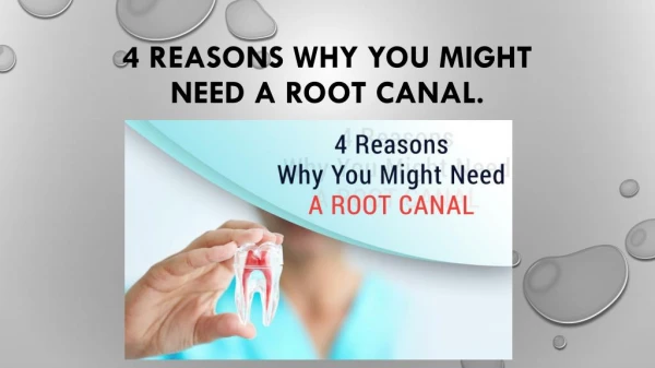 4 reasons why you might need a root canal