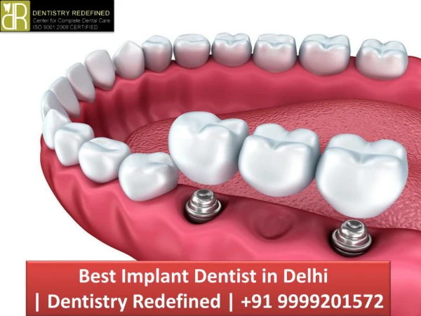 Best Implant Dentist in Delhi | Dentistry Redefined | 91 9999201572
