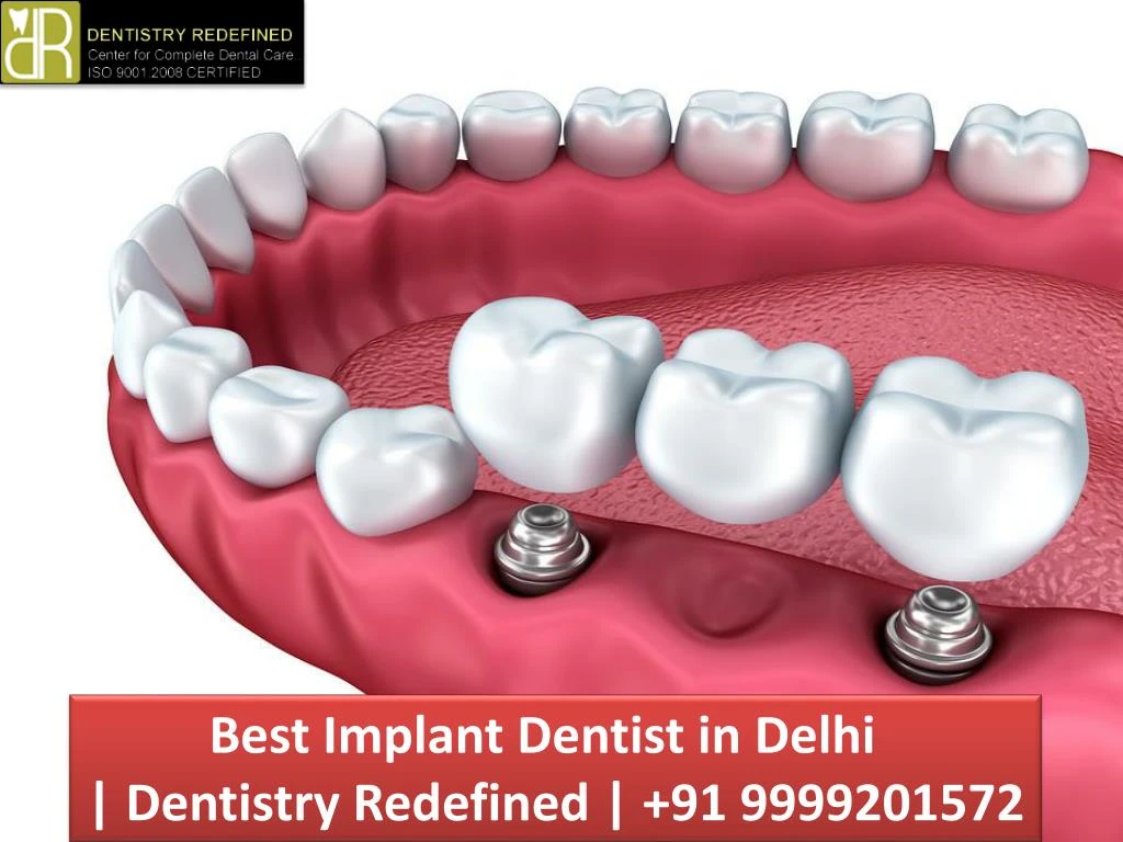 best implant dentist in delhi dentistry redefined