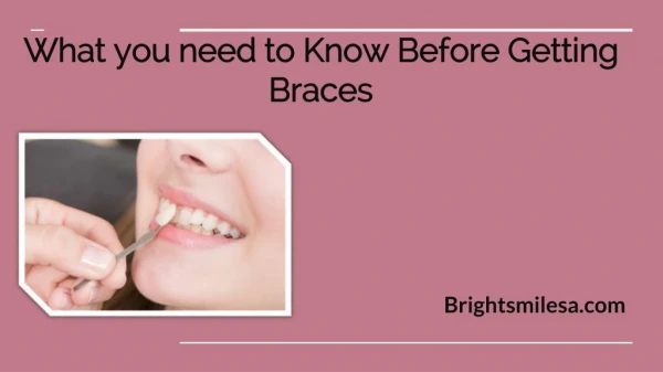 Some things to know before using Braces for teeth