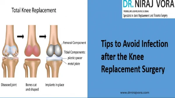 Tips to Avoid Infection after the Knee Replacement Surgery