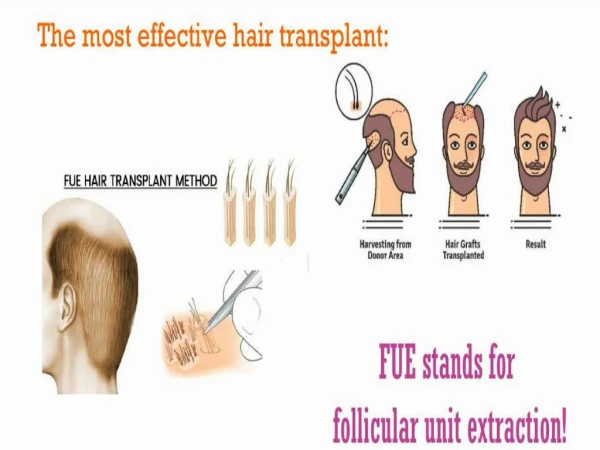 The most effective hair transplant