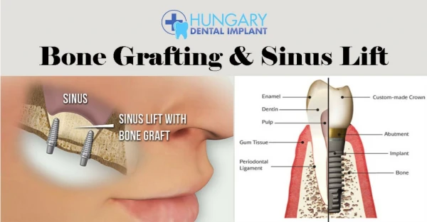 Bone Grafting Treatments in London, Budapest - Hungary Dental Implant