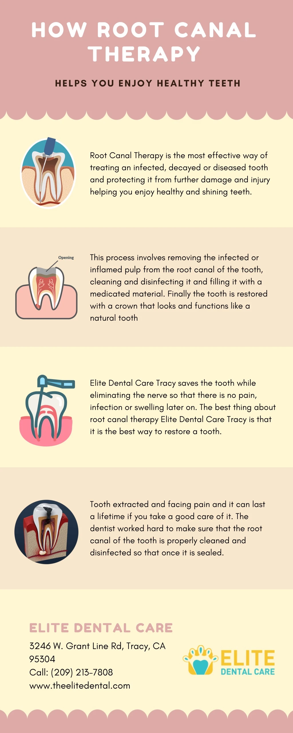 how root canal therapy