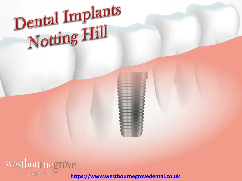 dental implants notting hill
