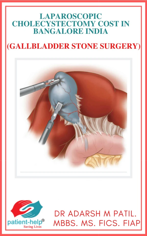 Gallbladder Stones Treatment In Bangalore