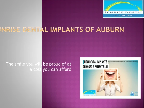 All-On-4 Dental Implants Auburn | Best Replacing missing Teeth Solutions