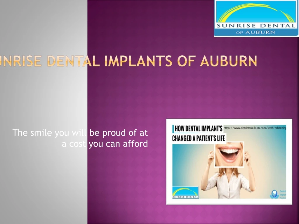 sunrise dental implants of auburn