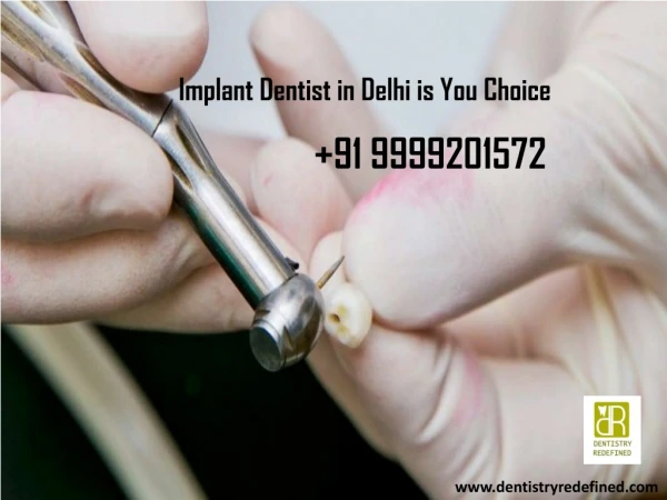 Implant Dentist in Delhi is You Perfect Choice
