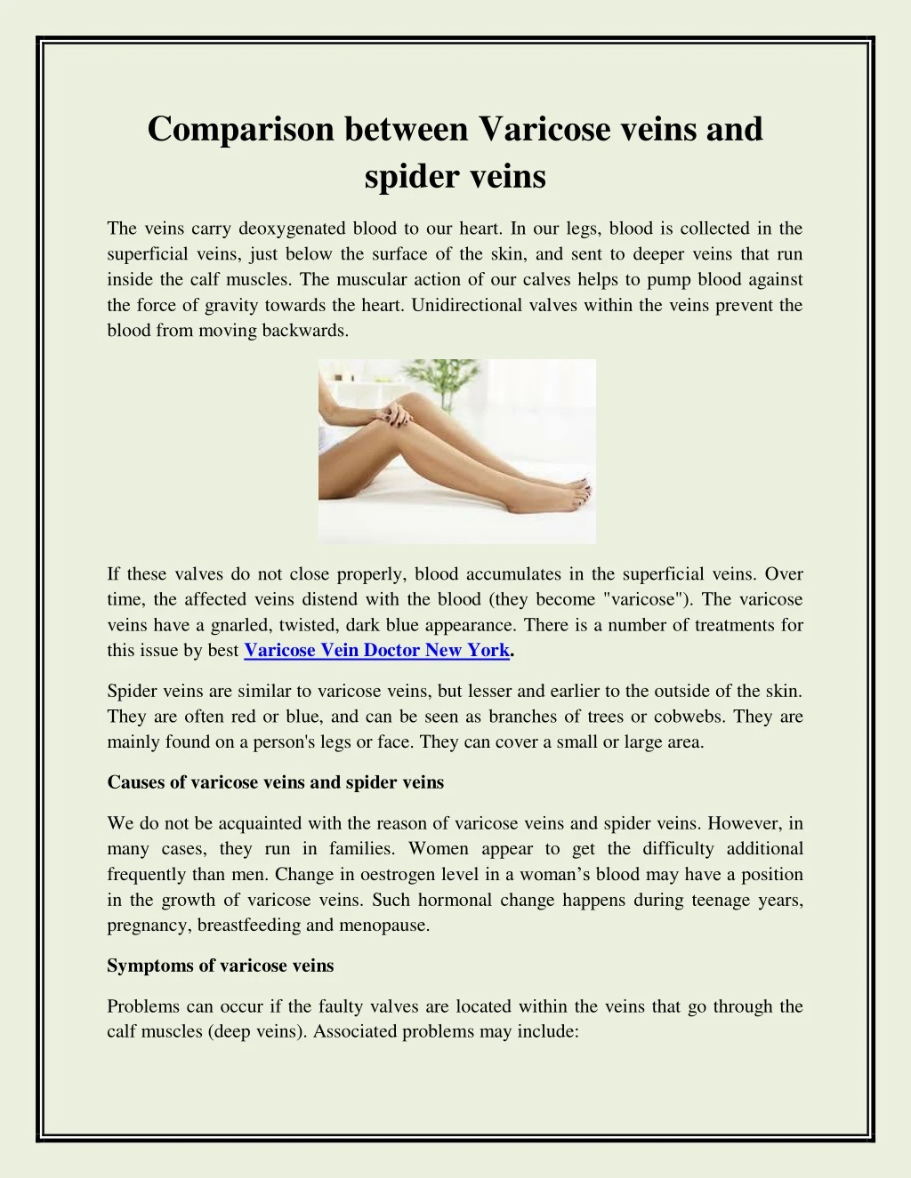 comparison between varicose veins and spider veins