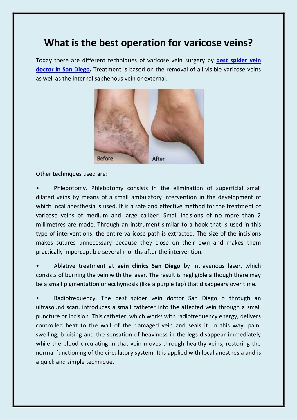what is the best operation for varicose veins